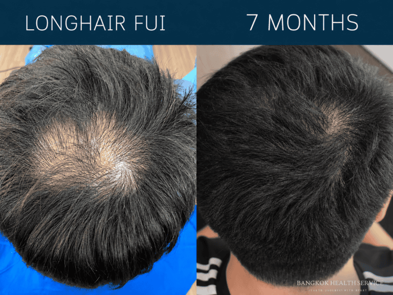Before and After Hair Transplant Crown