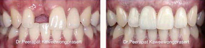 Dental Implants - Missing gaps are replaced by dental implants with ceramic crowns for natural look and feel