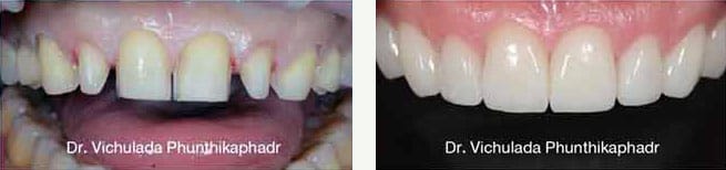 Dental Makeover Crowns and veneers used to lengthen teeth and change teeth shape to close gaps in teeth