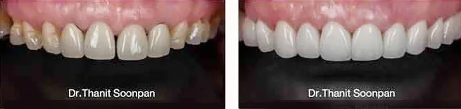 Dental Veneers - Porcelain veneers is one of the most common hollywood smile dental makeover treatment used to close gaps and change teeth color to guaranteed whiteness.