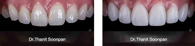 Digital Smile Design - Using digitalized technologies and porcelain veneers, smile is transformed for better shape and color