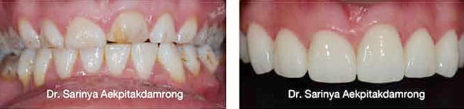 Porcelain Veneers - Veneers covers irregularities in teeth and lengthen teeth for better symmetry