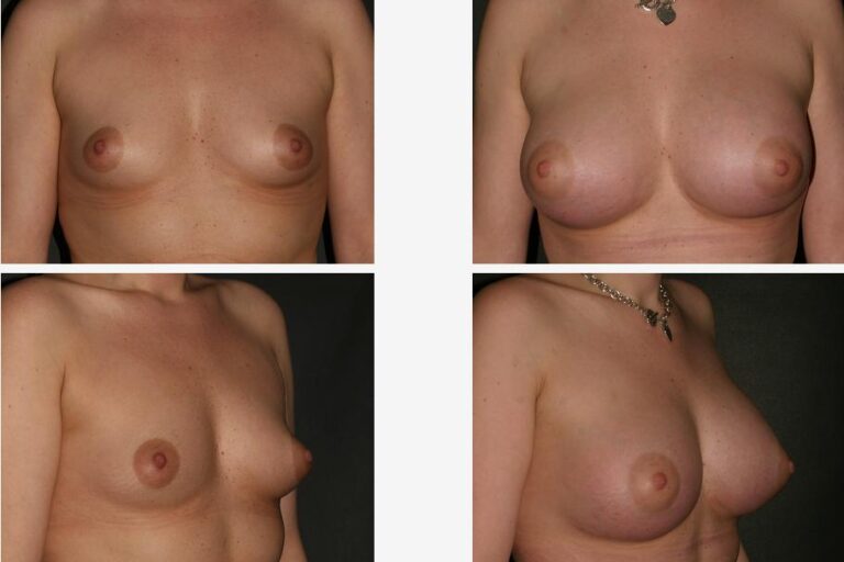 Breast Augmentation before and after