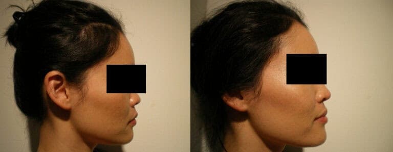 Rhinoplasty Local Anesthetics Surgery