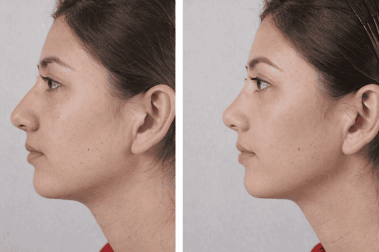 Bangkok Rhinoplasty Local Anesthetics Surgery 3 Nights Package