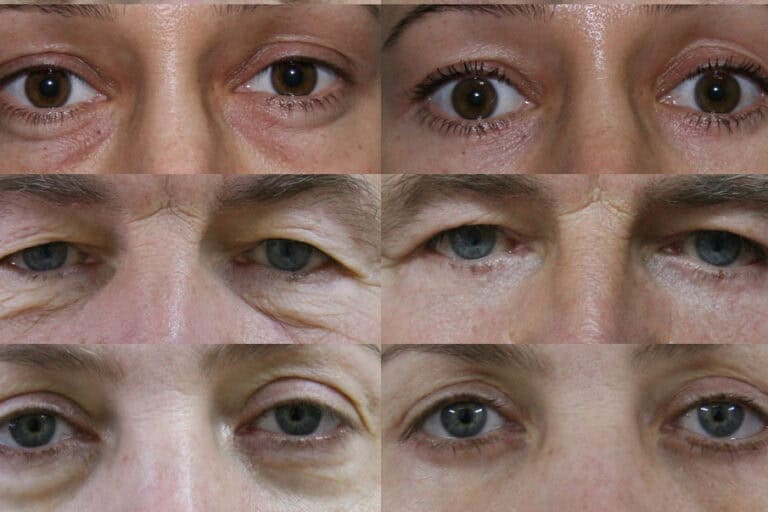 Upper or Lower Blepharoplasty Surgery