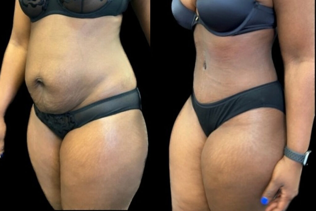 Tummy Tuck (Abdominoplasty)​