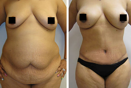 Abdominoplasty and Breast Augmentation & Lift