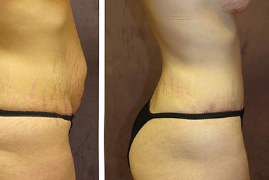 Abdominoplasty