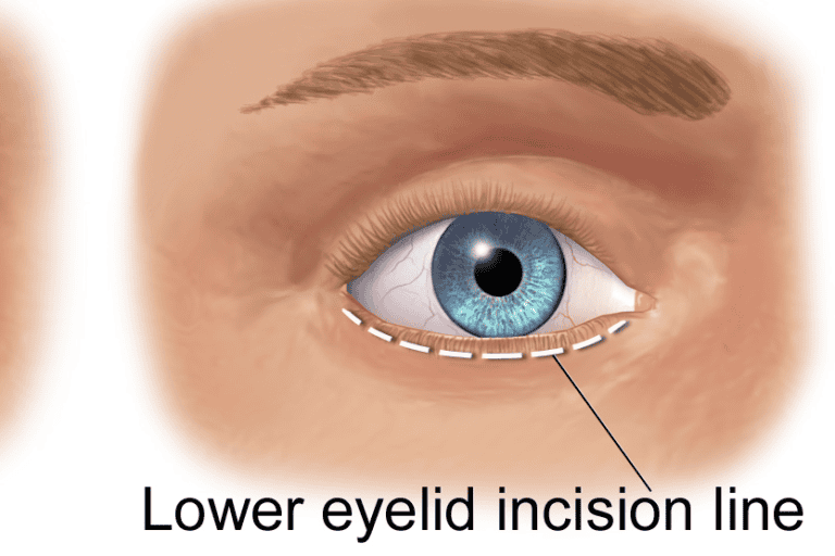 Eyelid Surgery (Blepharoplasty) Surgery