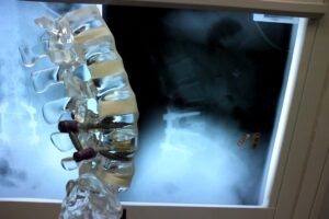 Spinal Fusion Cost in Thailand