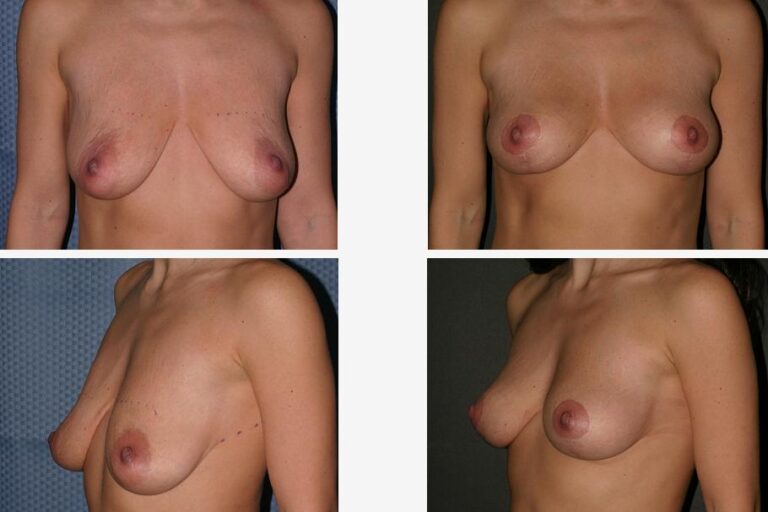 breast lift