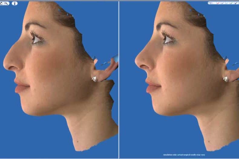Rhinoplasty before and after